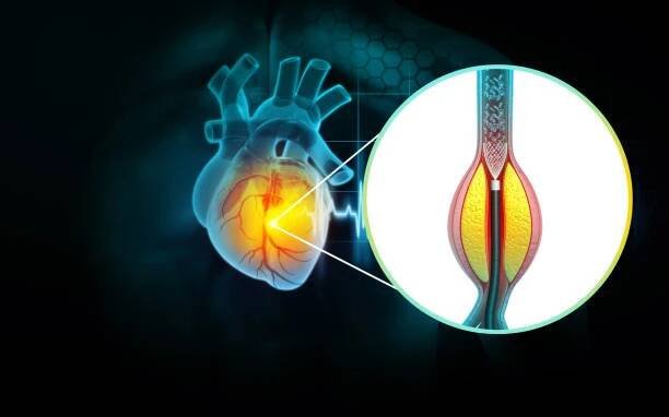 ucpaná tepna a onemocnění aterosklerózy. cholesterol blokoval tepnu. stent angioplastika. 3d ilustrace - stenty ilustrace - stock snímky, obrázky a fotky