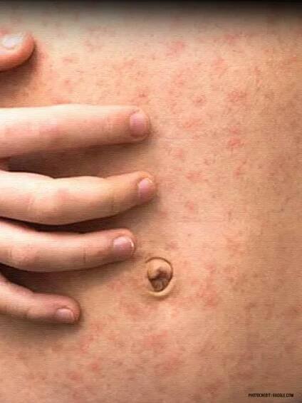 How Many Measles Outbreaks In 2024