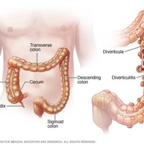 Facts About Diverticulitis and Diverticulosis