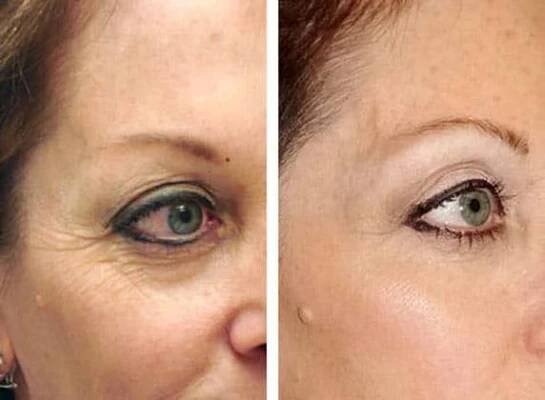 Thermage - oční víčka a oční okolí NOVÝM PŘÍSTROJEM - 2 ošetření