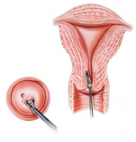 děložní hrdlo &amp; endocervix - biopsie - děložní hrdlo stock ilustrace