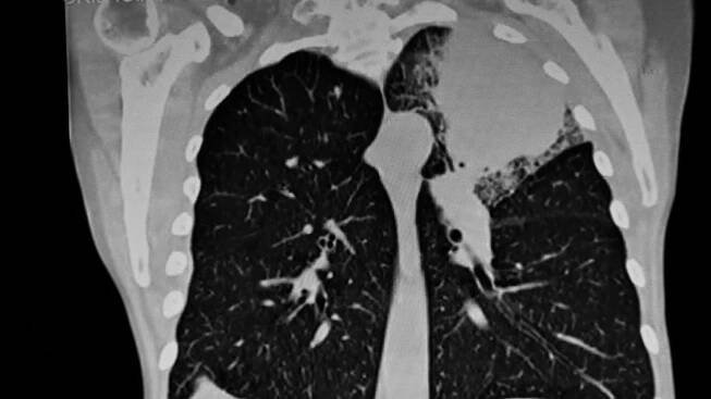 Rakovina plic: Jak zabíjí a kolik cigaret denně stačí na extrémní ...