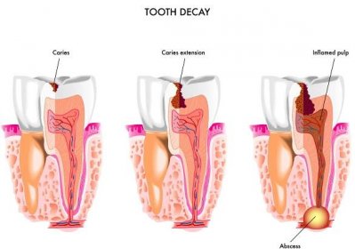 Tooth decay anatomy — Stockový vektor