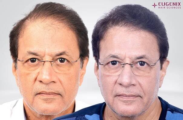 Arun Govil Front Before and After