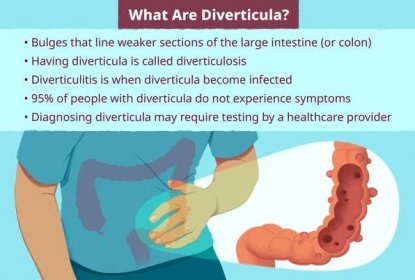 An illustration with information for the question "What Are Diverticula?"