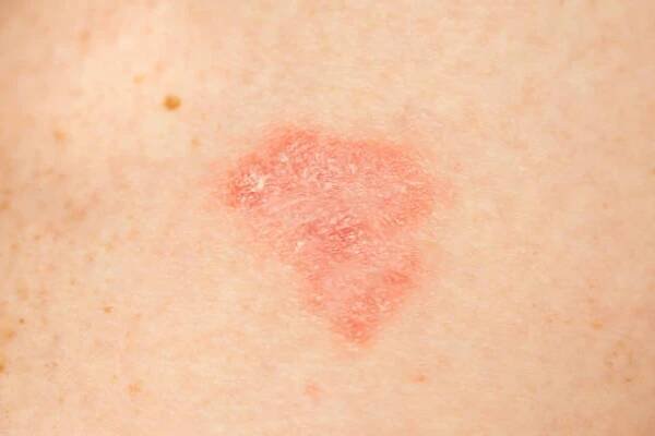 alergické vyrážky na kůži zblízka. psoriáza, atopická dermatitida, ekzém. kožní projevy. měkké zaostření, vybrané zaostření. - atopická dermatitis - stock snímky, obrázky a fotky