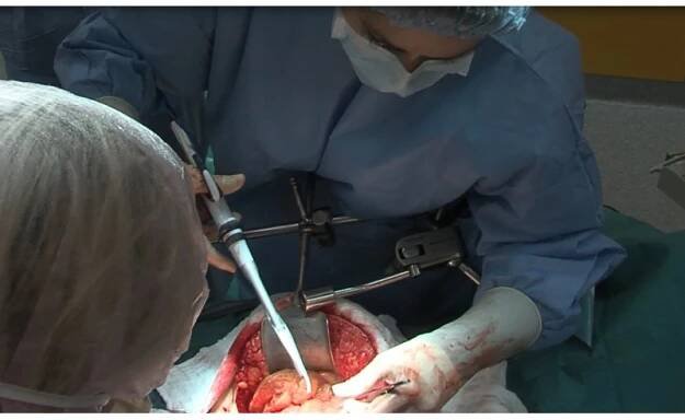 ČR - zdravotnictví - operační sál - lékaři - doktor - operace - střevo