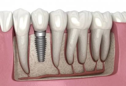 Importance Of Dental Implants For Better Oral Health