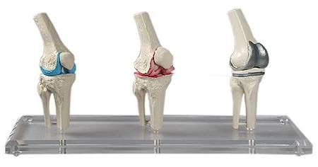 Totální endoprotéza kolenního kloubu, model