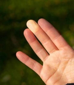 prsty s raynaudovým syndromem nebo raynaudovou chorobou. - sklerodermie - stock snímky, obrázky a fotky