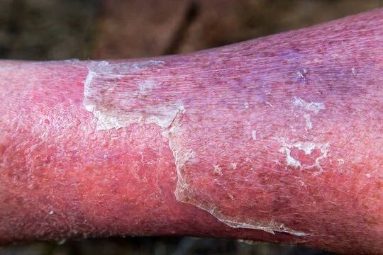 Cellulitis on leg and foot of mature diabetic man in daylight outdoors