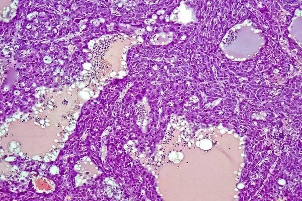 Hepatocelulární karcinom - jater rakovina v rat, 60 x zvětšení — Stock obrázek