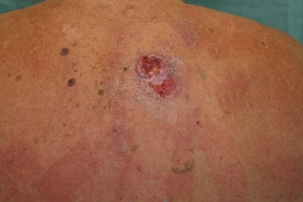 Z bazaliomu se může vyvinout vřed archiv Dermatovenerologické kliniky 2. LF UK a Nemocnice Na Bulovce