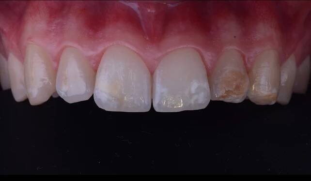 Dental bleaching and spot removal: goals and mistakes