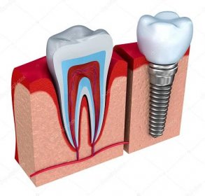 Anatomie zdravé zuby a zubní implantát v čelistní kosti.