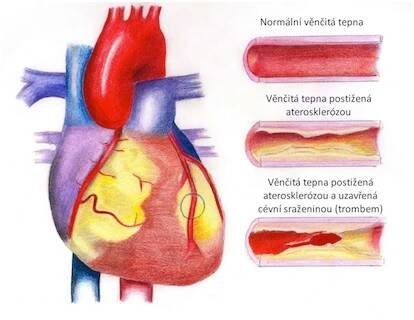 Ischemická choroba srdeční | Nemocnice České Budějovice a.s.
