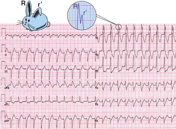 ECG ventricular tachycardia (wide complex tachycardia), RSR complexes with a taller left rabbit ear