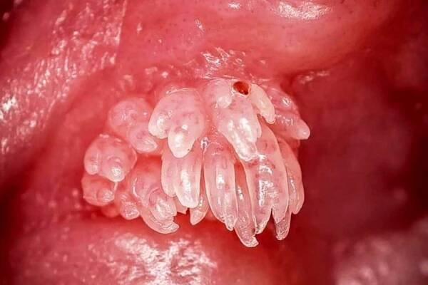 Papilloma Virus Infection and Prevention