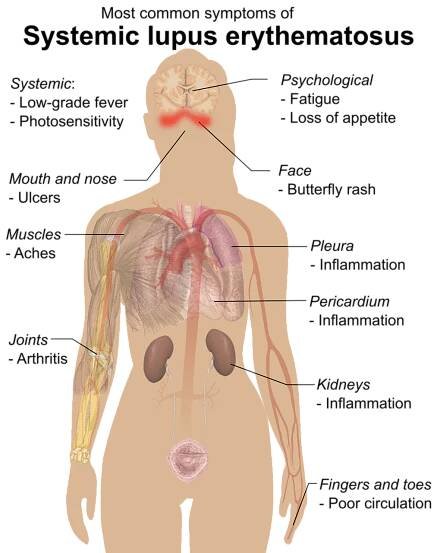Figure 17.6.6 Symptoms of Lupus