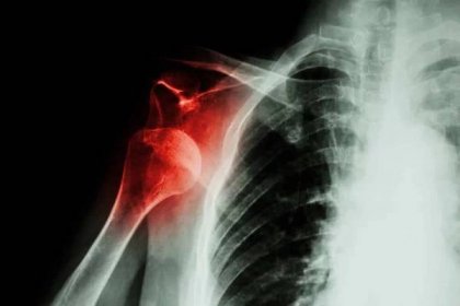 rentgenová přední dislokace ramene - klíční kost - stock snímky, obrázky a fotky