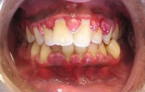 Gingivahyperplasie – Wikipedia