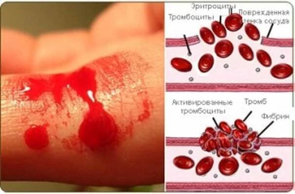 Krvácení z nosu může být znamením von Willebrandovy nemoci / Články | Užitečné informace a tipy na péči o sebe. Zdraví