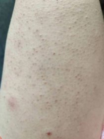 Alergie a ekzémy | Červené pupínky na stehnech