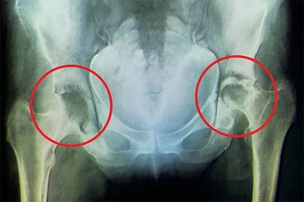 Rheumatoid arthritis is an autoimmune disease that attacks the joints. 
