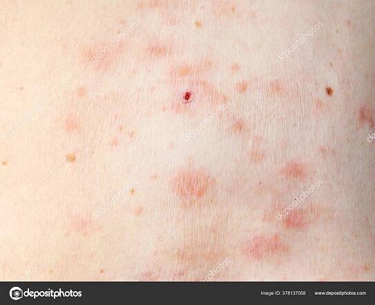 Kožní Vyrážka Léčba Těle Ženy Pásový Opar Choroba Herpes Zoster