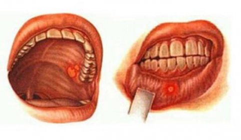 Onemocnění ústní sliznice / Onemocnění ústní sliznice