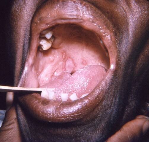 Herpes Simplex Virus (HSV) Infections - Infectious Diseases - Merck Manual Professional Edition
