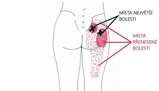 Piriformis syndrom alias bolest „zadkového“ svalu – část první |  Fyzioterapie online