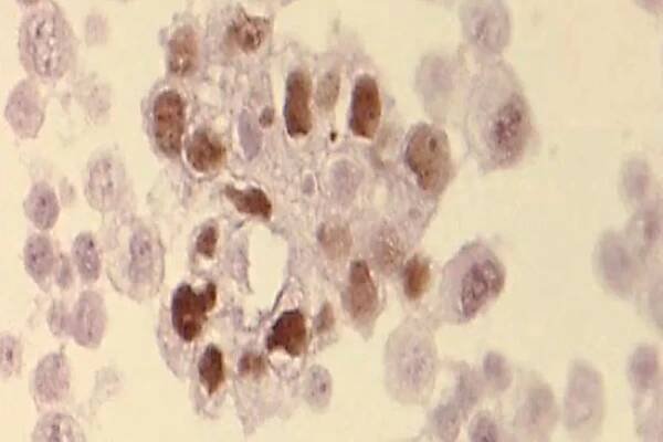 Wilms-Tumor 1