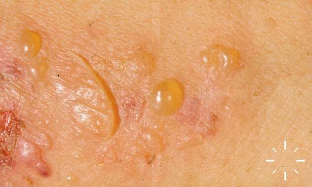 DermaCompass - Bullous pemphigoid 