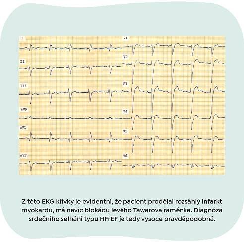 QR EKG pacienta po AIM - Česká aliance pro kardiovaskulární onemocnění