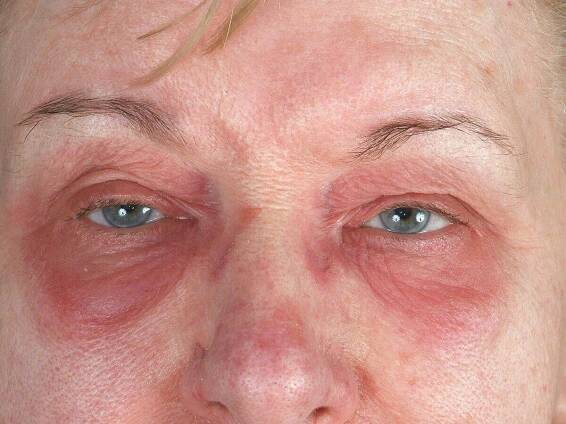 Dermatomyositis (overview)