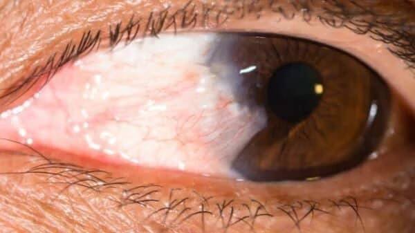 Pterygium a Pinguecla 600x338