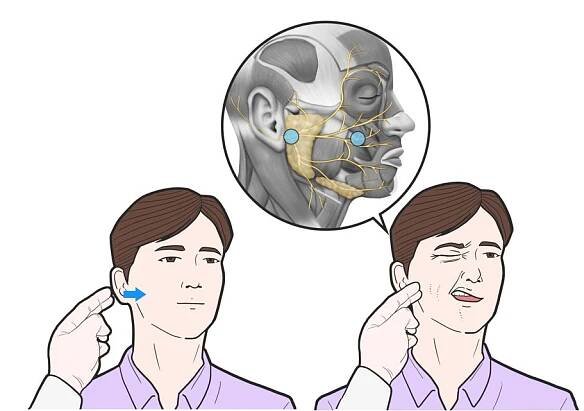 Positive Chvostek Sign – My Endo Consult