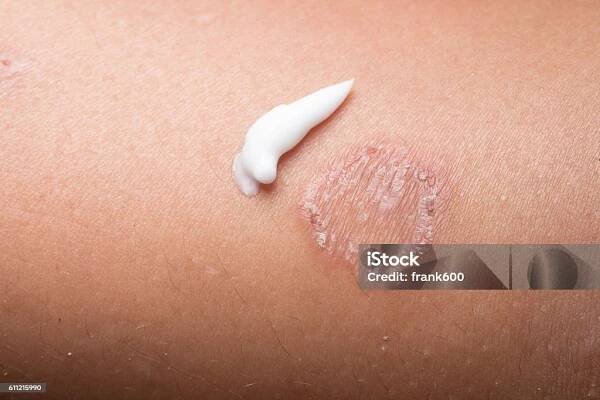 Infekce kroužkovým červem, dermatofytóza - Bez autorských poplatků Trichoficie Stock fotka