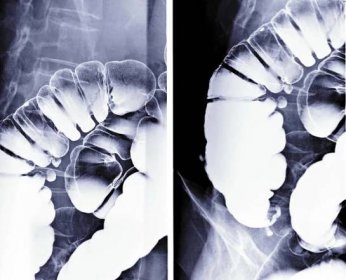 baryový klystýr nebo rentgenový obraz tlustého střeva ukazující divertikulitidu tlustého střeva. - příčný tračník - stock snímky, obrázky a fotky
