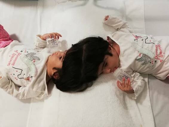 Safa and Marwa, craniopagus twins, lie on a bed pre-surgery. They are drinking water.