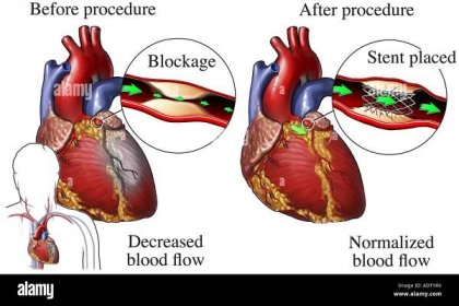 Coronary Artery Stent