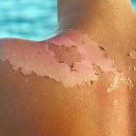 How to care for your sunburn to minimise causing further damage