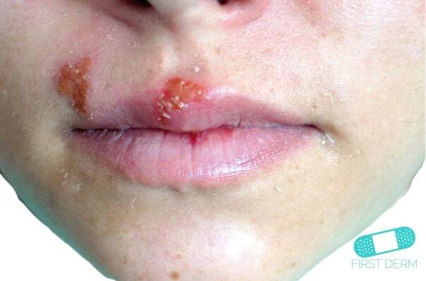 Oral Herpes Simplex (Cold sores)