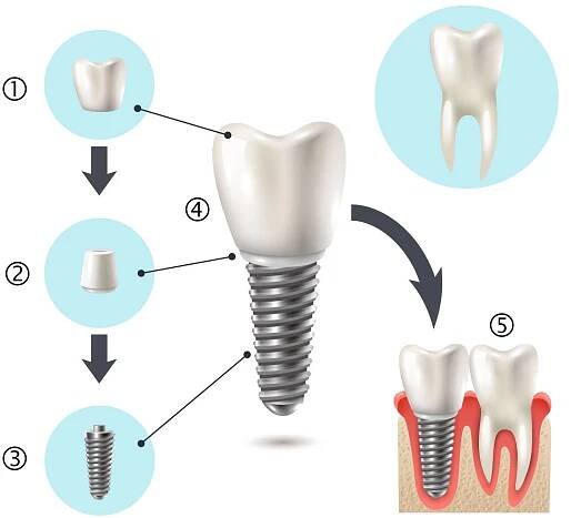 zubní implantát: umělá náhrada zubu