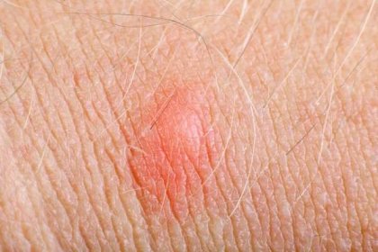 Extrémní closeup alergie pupínek na mužské kůži — Stock obrázek