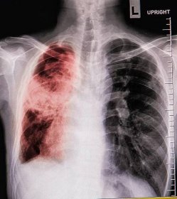 pacienti se zápalem plic rentgenový film. - bronchitida fotky - stock snímky, obrázky a fotky