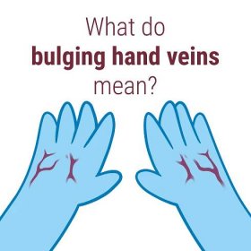bulging veins in legs Archives - Delaware Vein Center