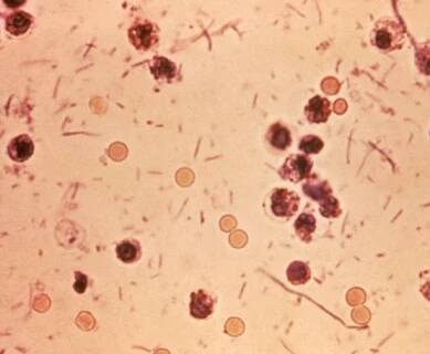 Shigella infekce (shigellóza) – co je to – příznaky, příčiny a léčba