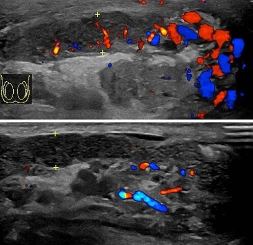 Doppler ultrasound of epididymitis, seen as a substantial increase in blood flow in the left epididymis (top image), while it is normal in the right (bottom image). The thickness of the epididymis (between yellow crosses) is only slightly increased (7 mm).